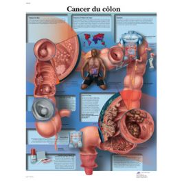 Cancer du côlon VR2432UU à 9.03