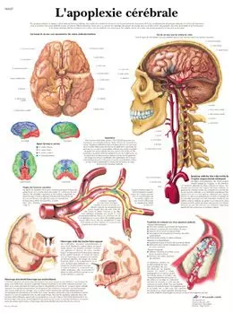 Planche anatomique Apoplexie cérébrale VR2627L